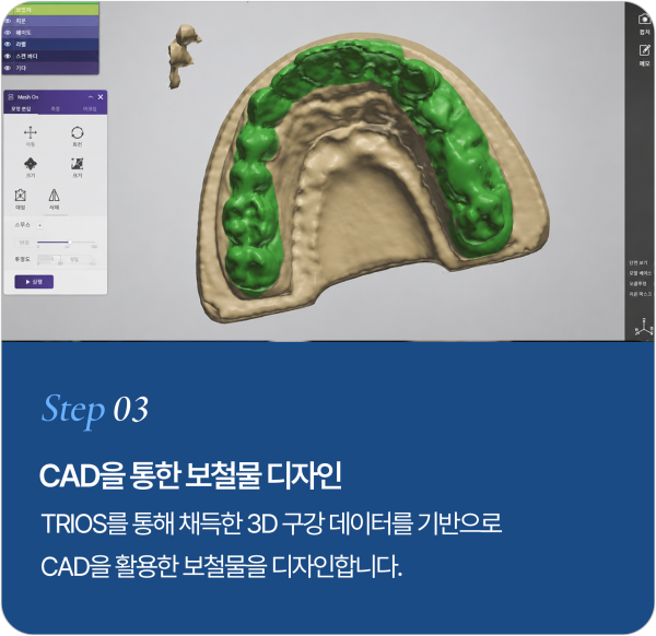 보철물 제작 과정 Step 3