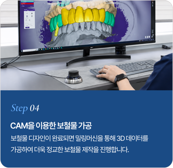 보철물 제작 과정 Step 4