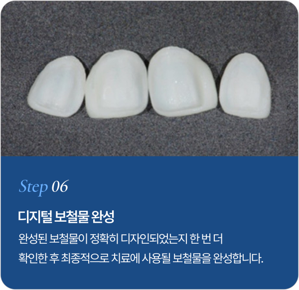 보철물 제작 과정 Step 6